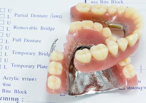 Metal Dentures Thousand Oaks CA 91360